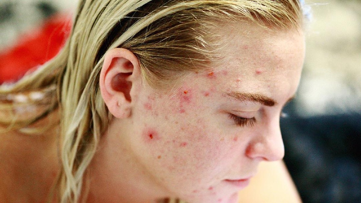 cara-ampuh-mengatasi-jerawat-di-dagu-versi-dermatolog