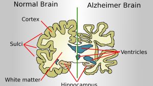 studi-baru-ungkap-gaya-hidup-yang-bisa-mengurangi-risiko-alzheimer