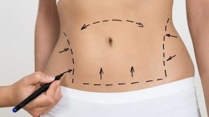 tak-usah-langsung-sedot-lemak,-ini-ada-6-cara-buang-buncit-di-perut