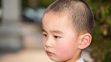 tampek-pada-anak:-penyebab,-gejala,-cara-mengobati-dan-bedanya-dengan-campak