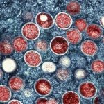 5-pria-positif-monkeypox-usai-kunjungi-sauna-khusus-gay