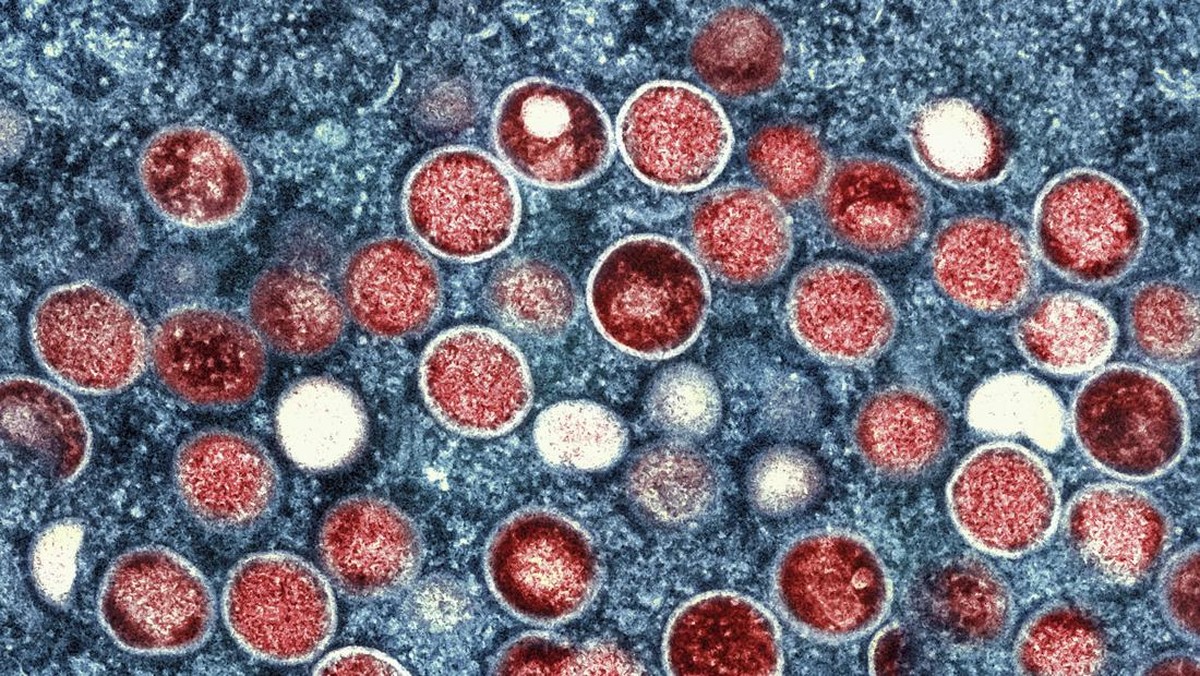 5-pria-positif-monkeypox-usai-kunjungi-sauna-khusus-gay